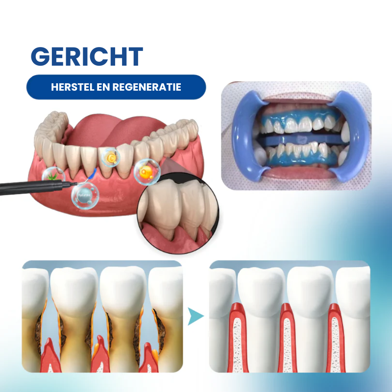 GumRestore™ | Terugtrekking, pijn en irritatie tegelijkertijd aan | 1+1 gratis